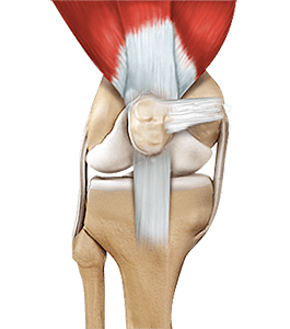 Quadriceps Tendon Repair