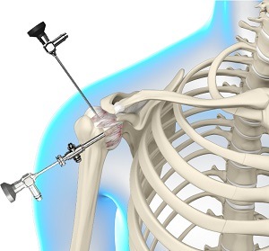 Arthroscopic Frozen Shoulder Release