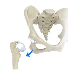  Hip Dislocation 