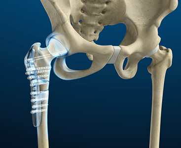  Hip Fracture Surgery