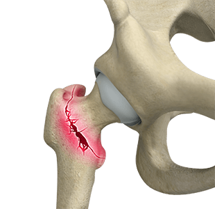 Hip Fracture