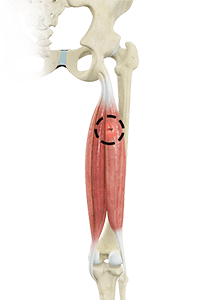 Hamstring Injuries