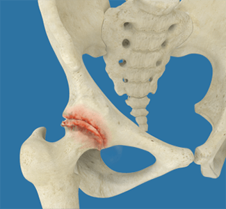 Osteoarthritis of the Hip