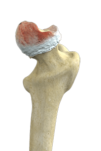  Hip Osteonecrosis 
