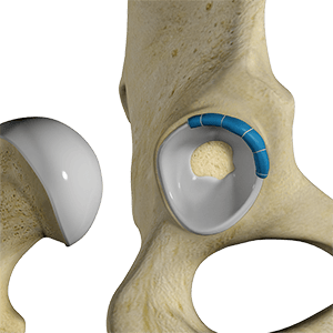    Hip Trauma Reconstruction 