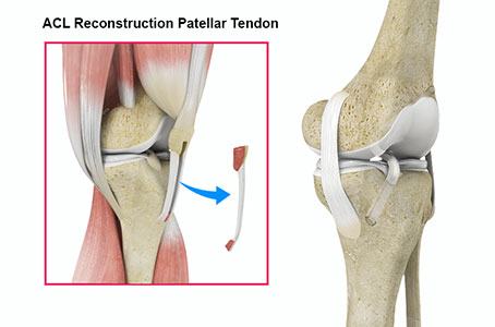  ACL Reconstruction 