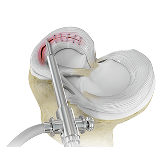 Meniscal Surgery