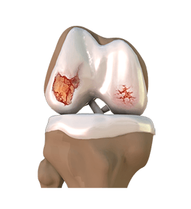 Knee Osteoarthritis