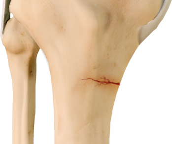 Knee Fracture Surgery