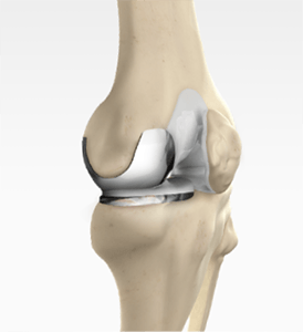 Partial Knee Replacement