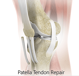 Patellar Tendon Repair