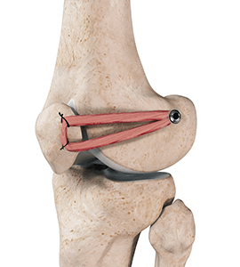 Patellofemoral Knee Replacement