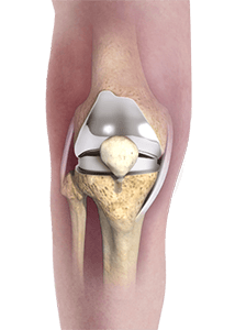 Patient Specific Knee Replacement