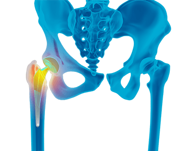 Revision Hip Replacement