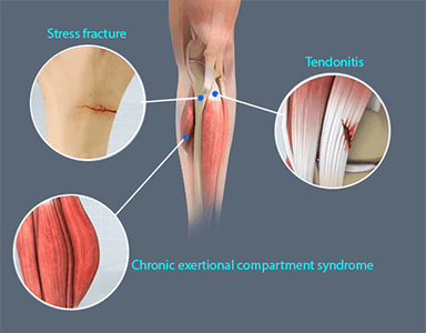 Shin Splints