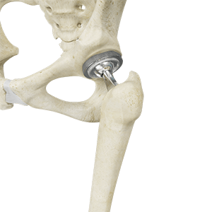 Total Hip Replacement