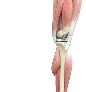 Total Knee Replacement