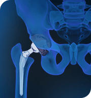 Joint Replacement